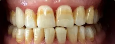 变色型（中度）氟斑牙
