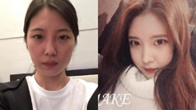 韩国美可整形李圣俊眼鼻面部填充前后对比照片 韩国美可整形李圣俊眼鼻面部填充前后对比照片