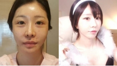 韩国维摩整形医院全脸脂肪填充前后照片