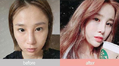 韩国朱诺鼻子修复整形官网案例