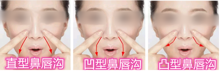 鼻唇沟类型