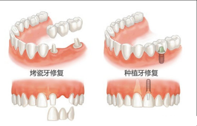 牙齿修复方式对比