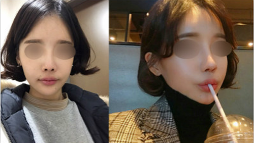 韩国Thenan自体肋软骨隆鼻真人日记