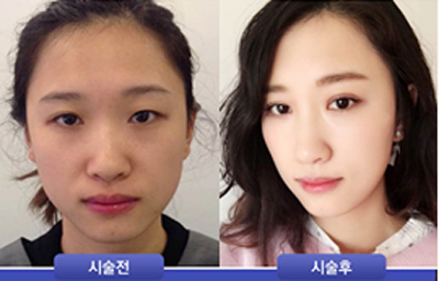 韩国111整形外科眼鼻综合案例对比效果