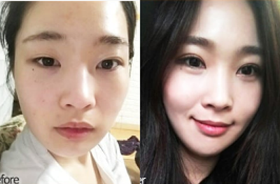 韩国themoon整形外科脂肪填充+眼综合手术对比案例