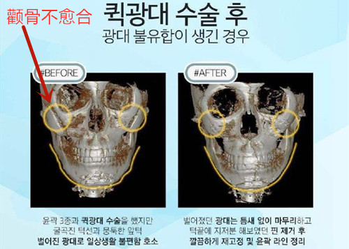 韩国丽珍整形颧骨修复案例