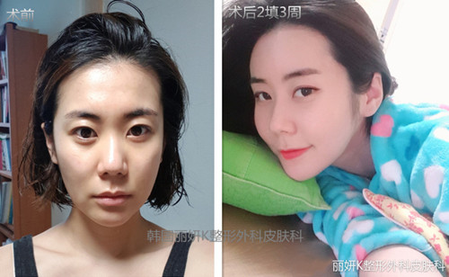 丽妍K整形面部填充效果对比照片