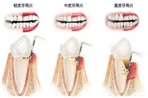 牙周炎治疗示意图