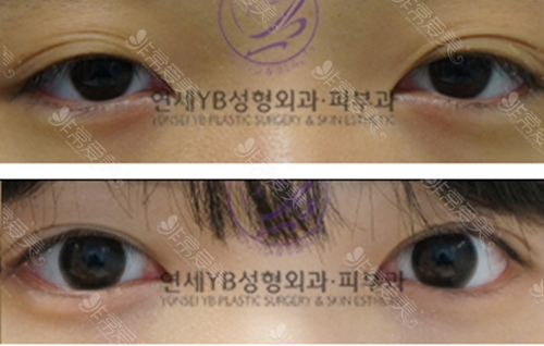 韩国延世YB整形外科医院双眼皮手术效果图