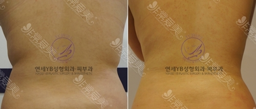 韩国延世YB整形外科医院背部吸脂效果图