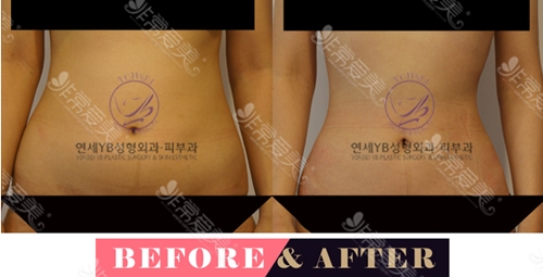 韩国延世YB整形外科医院腰腹吸脂真人案例
