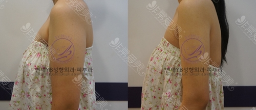 韩国延世YB整形外科医院蝴蝶袖手臂抽脂案例