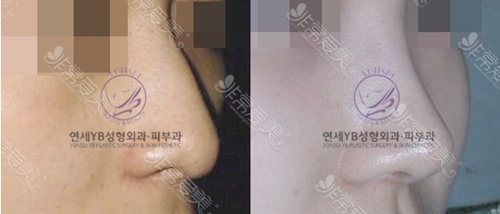 韩国延世YB整形外科鼻部整形日记