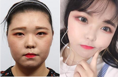 韩国HB整形外科眼部手术日记