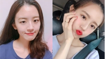 韩国普瑞美双眼皮眼型矫正前后照片