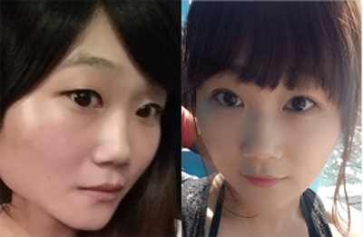 韩国维德整形外科眼部手术对比案例