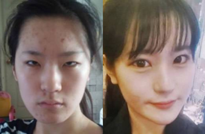 韩国k-beauty柳重锡眼睛案例前后对比图