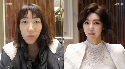 韩国菲斯莱茵整形医院面部轮廓+双鄂改善案例 韩国菲斯莱茵整形医院面部轮廓+双鄂改善案例