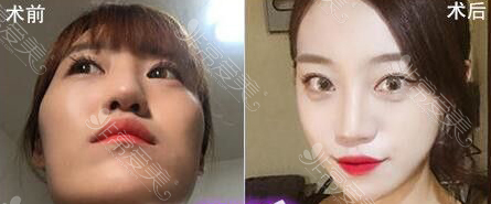 韩国美迪莹整形外科面部轮廓案例 韩国美迪莹整形外科面部轮廓案例