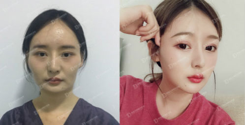 韩国女神整形外科颧骨整形案例 韩国女神整形外科颧骨整形案例