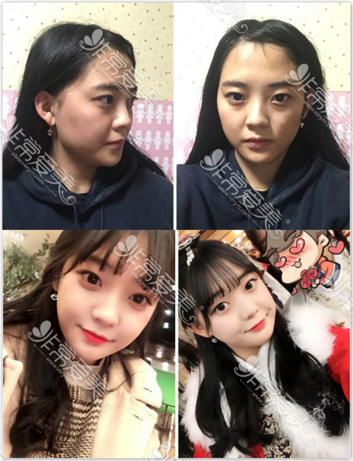 韩国医院颧骨整形真人案例 韩国医院颧骨整形真人案例
