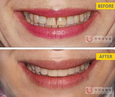 韩国SU牙科医院牙齿整形案例图