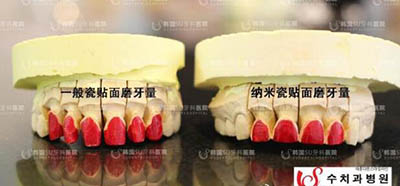 韩国SU牙科医院磨牙量