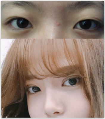韩国双眼皮整形案例对比