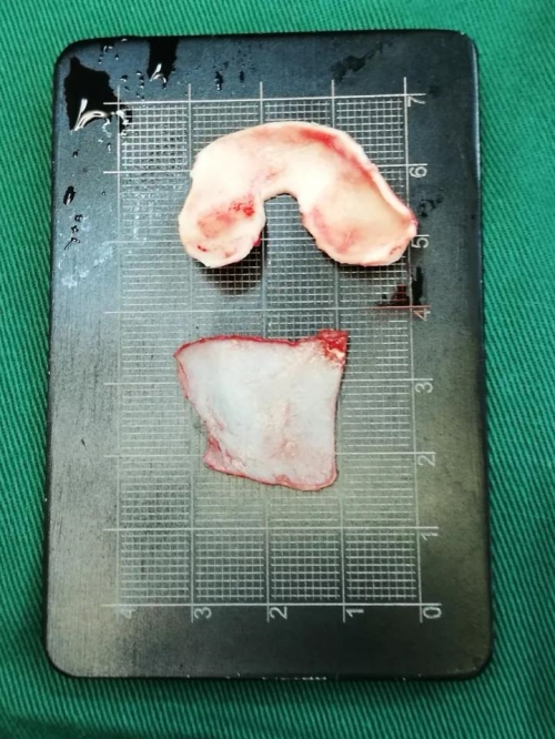 手术中取出的耳软骨以及鼻中隔软骨