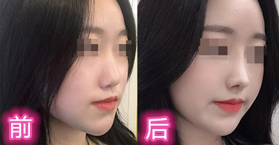 隆鼻术后变化大吗