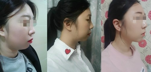 有什么办法可以瘦脸