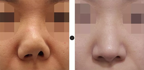 韩国韩娜鼻整形外科手术案例