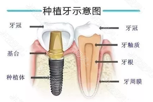 烤瓷牙坏了能补吗