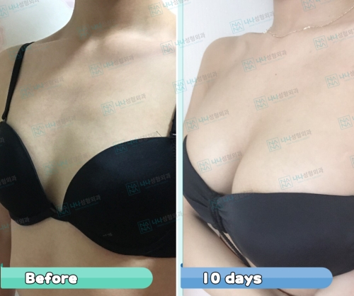 韩国娜娜整形外科隆胸案例对比图