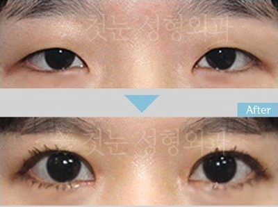 韩国初雪医院双眼皮手术