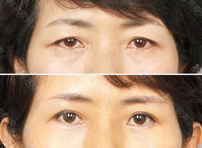 韩国ID医院提眉手术前后对比照片
