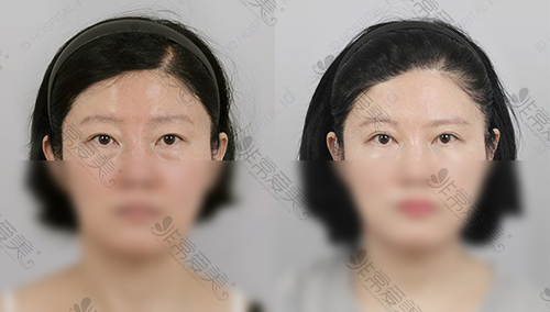 韩国ID医院提眉手术前后对比照片