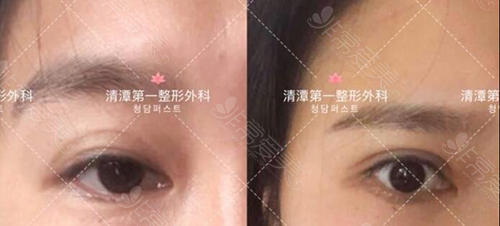 韩国清潭first医院眼手术案例 韩国清潭first医院眼手术案例