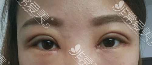 清潭医院眼睛术后即可图 清潭医院眼睛术后即可图