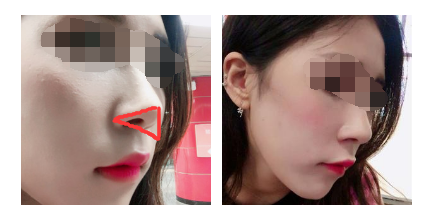 尹贤哲驼峰鼻矫正+鼻综合整形前后对比照