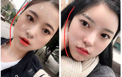 面部吸脂埋线提升案例 面部吸脂埋线提升案例