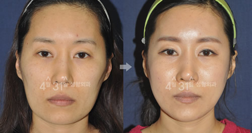 4月31整形外科隆鼻修复案例