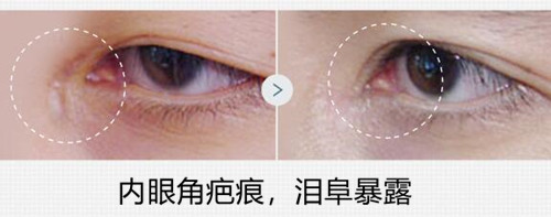 韩国Swan整形眼角疤痕修复案例