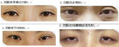 双眼皮做坏了多久以后能做修复