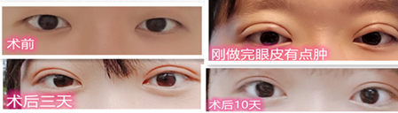 双眼皮完全愈合要多久