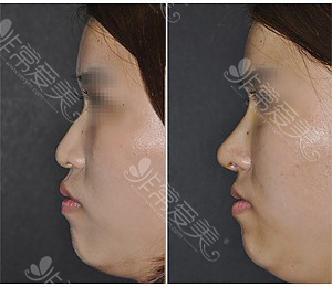 韩国WILL整形外科鼻基底+隆鼻效果明显