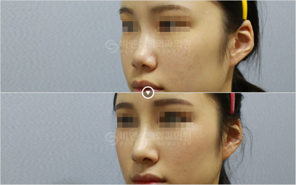 韩国BN医院鼻部整形案例