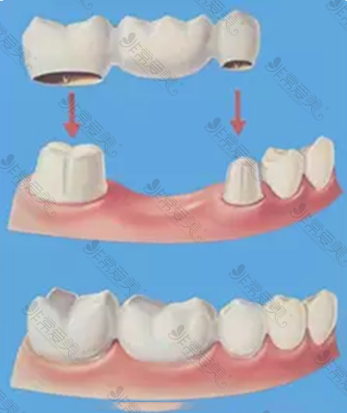 但假如剩余的天然牙条件不适合镶固定假牙,又不能接受活动假牙的不便