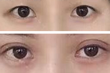 双眼皮不协调怎么办