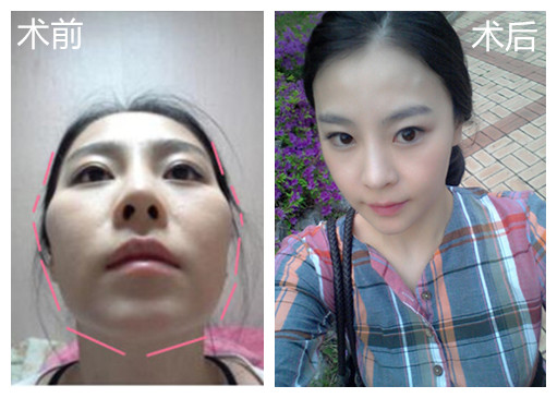 韩国原辰颧骨、下颌角整形真人案例